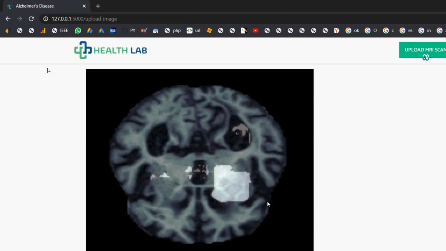 Alzheimer Early Detection CNN MLP in Python Projects